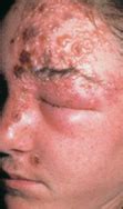 In this disease, the pitta dosha is responsible factor for these rashes may involve the face, eyes, mouth and ears. How to Manage Acute Herpes Zoster Affecting Trigeminal Nerves | jcda
