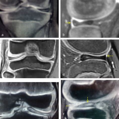 Wrisberg Variant Of The Lateral Discoid Meniscus In Children Review Of