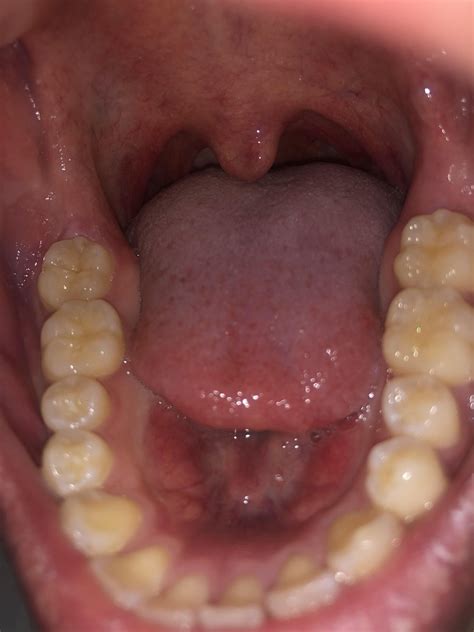 Swollen Gum Behind Second Molar No Wisdom Tooth X Rayed Is This