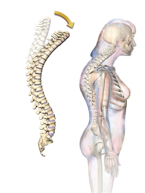 What Is The Difference Between Scoliosis Kyphosis And Lordosis Pediaacom
