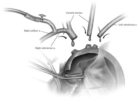 One Stage Repair Of Extensive Thoracic Aortic Aneurysm Using The Arch