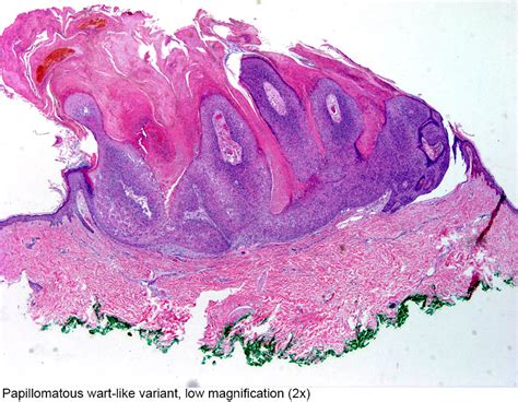 Pathology Outlines Inverted Follicular Keratosis