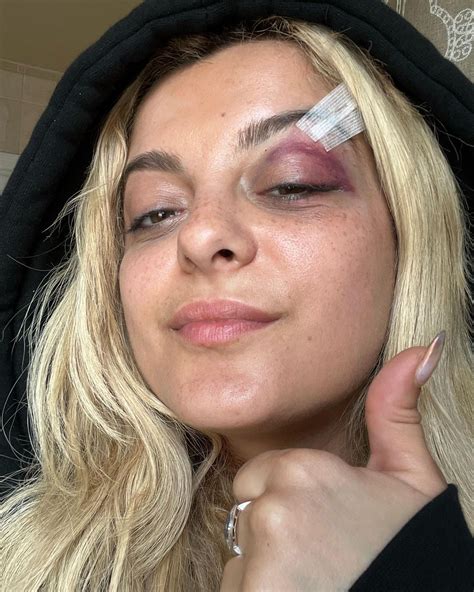 Bebe Rexha Shows Off Black Eye After Fan Chucks Phone At Her