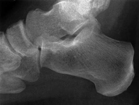 Fractures Of The Calcaneus A Review With Emphasis On Ct Radiographics