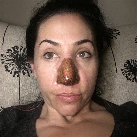 Woman Has Skin Burned Off After Nose Doubled In Size Due To Rare