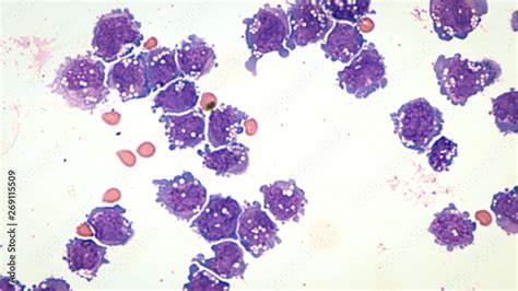 Malignant Effusion Cytology Microscopic Image Of Diffuse Large B Cell