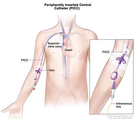 Definition Of Peripherally Inserted Central Catheter Nci