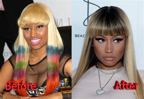 Nicki Minaj Plastic Surgery: Fact or Not?