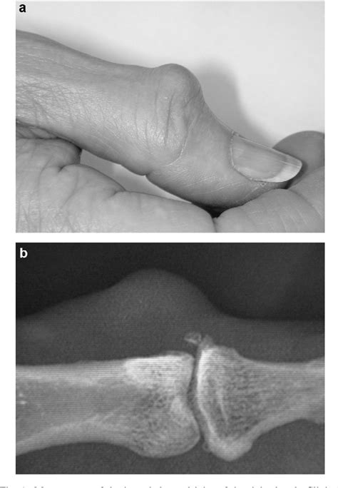 Figure 2 From Surgical Treatment Of Mucous Cysts By Subcutaneous
