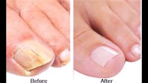 As the nail grows gradually, it will probably push out the remaining splinter. How To Get Rid Of Toenail Fungus Fast And Naturally -Toe ...