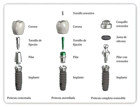 Prótesis Sobre Implantes En Sevilla Seprolab Dental