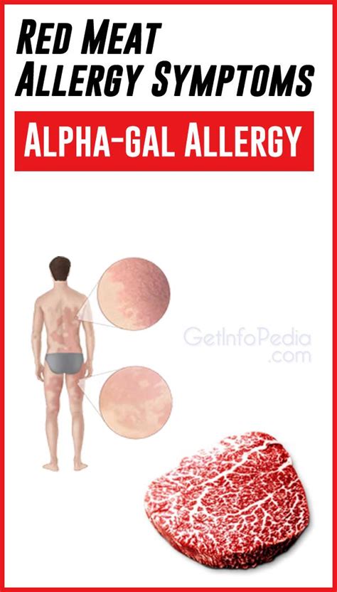 Red Meat Allergy Symptoms Alpha Gal Allergy Red