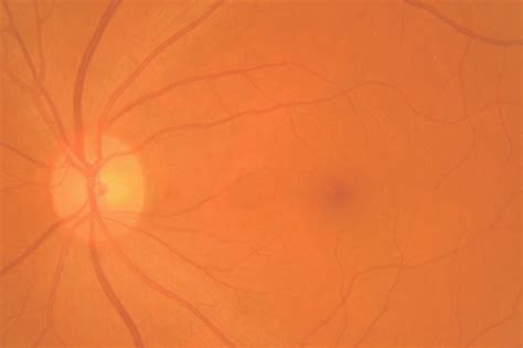 Causes Of Epiretinal Membrane Southern Vitreoretinal Associates