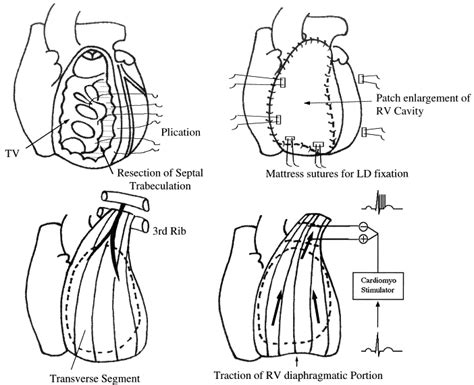 Configuration Of Linear Dynamic Cardiomyoplasty For Hypoplastic Right