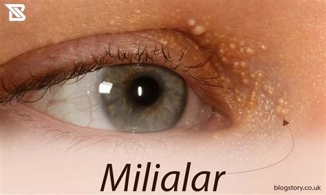 Milialar Everything You Should Know About This Skin Condition
