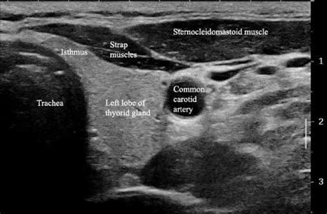 Normal Parathyroid Gland Ultrasound