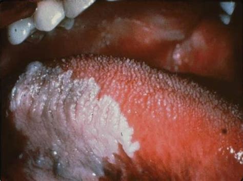 These patches often peel off. Leukoplakia Symptoms, Causes, Diagnosis and Treatment ...