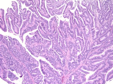 Pathology Outlines Intra Ampullary Papillary Tubular Neoplasm Iapn