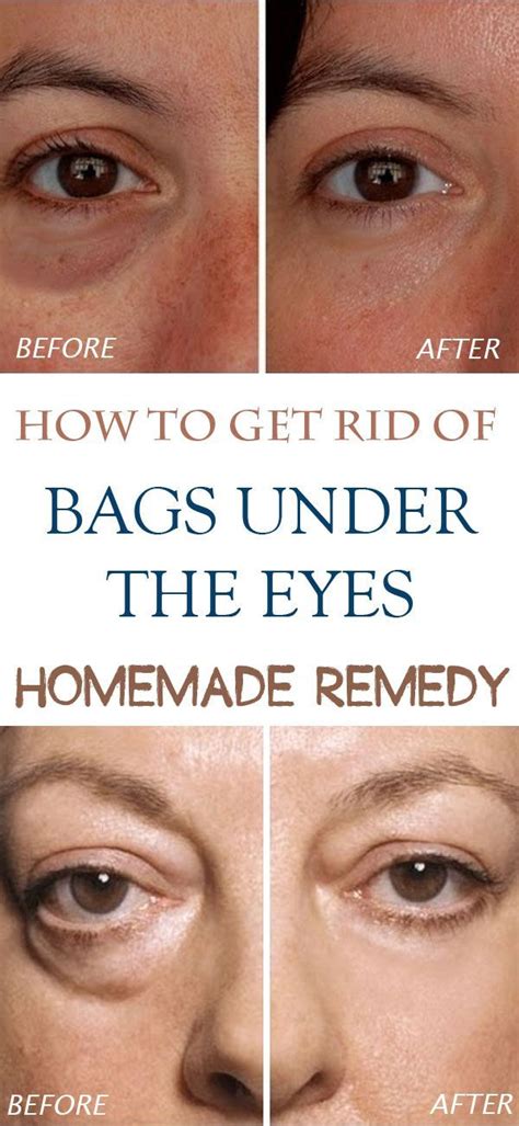 How To Get Rid Of Puffy Eyes Quick Easy And Natural Read Under