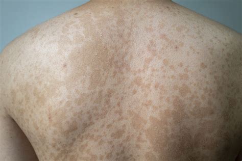 Everything You Need To Know About Tinea Versicolor Tinea Versicolor Treatments Skin And