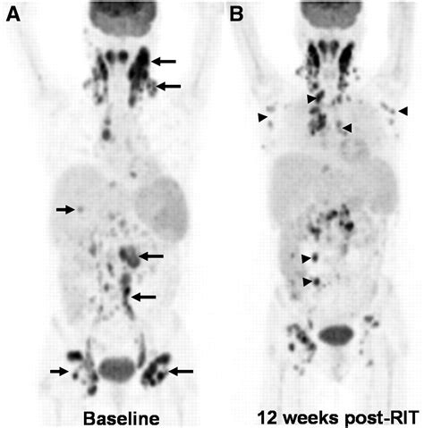 18f Fdg Petct For Monitoring The Response Of Lymphoma To
