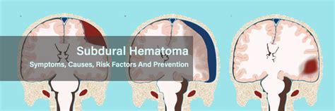 Subdural Hematoma Symptoms Causes Risk Factors And Prevention