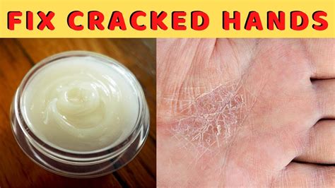 Natural Home Remedy For Dry Severely Cracked Hands And Fingers Fix