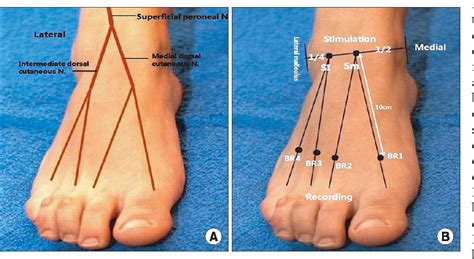 Figure 1 From Nerve Conduction Study Of The Superficial Peroneal