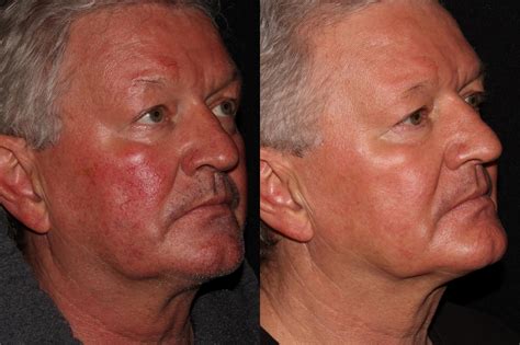 BBL PhotoFacial Before And After Pictures Case Chico Yuba City Oroville CA Hodari MD