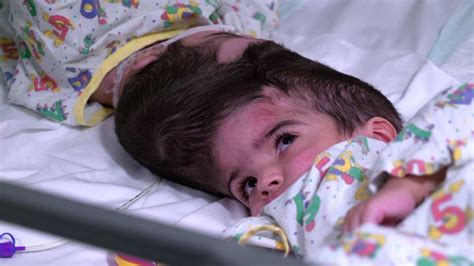 Twins Conjoined At The Head Are Separated After 50 Hours Of Surgery