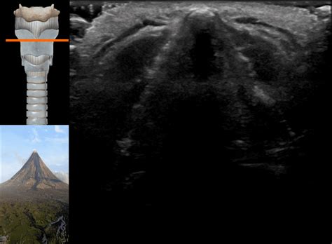Airway Ultrasound Transverse Views • Litfl • Ultrasound Library