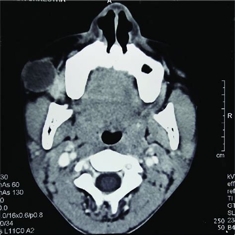 Ct Scan Of Head Showing Cystic Lesion In The Right Buccal Space