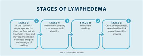 What Is Lymphedema Tactile Medical