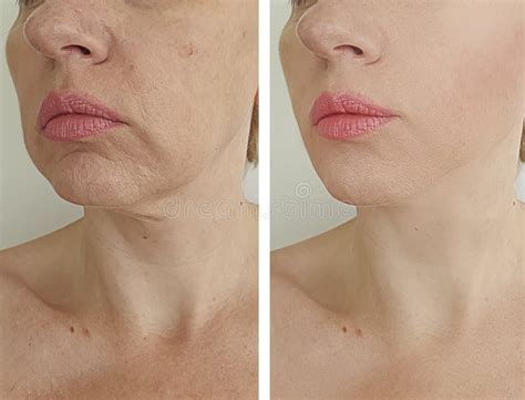 Wrinkles Woman Sagging Face Before And After Treatment Stock Image