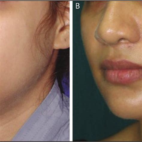 A Pre Procedural Image Showing Prominent Submental Fat Pad Double