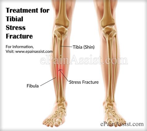 Tibial Stress Fracturesymptomscausesdiagnosistreatment