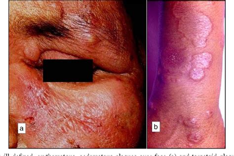 Figure 1 From Erythema Nodosum Leprosum Mimicking Sweets Syndrome An