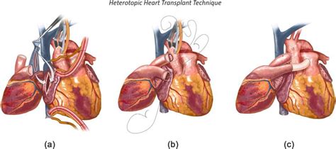 Evolution Of Heart Transplantation Surgical Techniques Intechopen