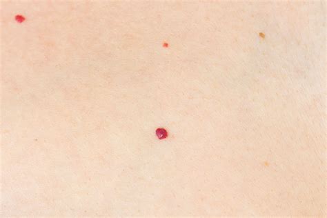 What Are Cherry Angiomas Avail Dermatology