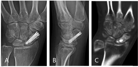 Frontiers Clinical Outcomes Of Double Screw Fixation With Bone