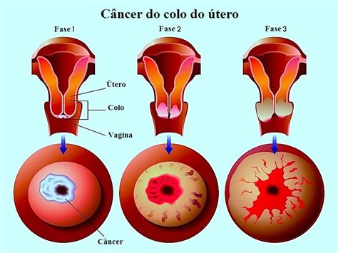 Advierten sobre los beneficios de controles ginecológicos para prevenir cáncer de útero. Cancro do colo do útero, sintomas, vacina, tratamento e ...