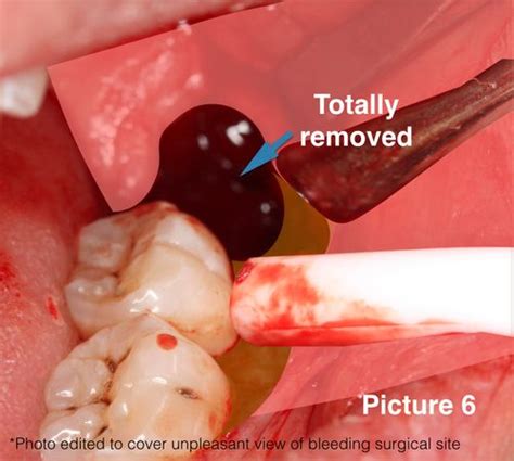 Wisdom Tooth Surgery Union Dental