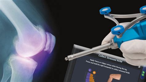 Robotic Surgery Advances Orthopedic Care At Cmc