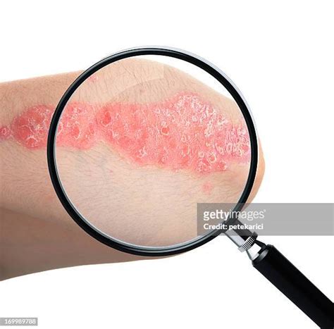 Psoriasis Stock Photos And Premium High Res Pictures Getty Images