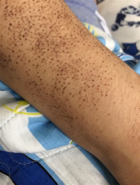 I Have Had These Spots All Over My Arms And Legs For Several Years It Hasnt Gone Away And I