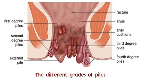 Thrombosed hemorrhoids present as a single pile or a circle of piles. Hemorrhoids. Comprehensive introduction covers symptoms ...