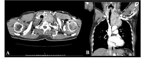 Figure 1 From A Case Of Cervico Mediastinal Paraganglioma Mimicking An
