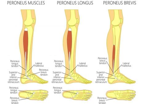 Peroneal Tendonitis Symptoms And Treatment For Peroneal Tendonitis