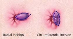 Persons with thrombosed external hemorrhoids usually present with pain on standing, sitting or defecating. Piles Clinic in Mumbai Call: +91 9820528728 Top Piles Doctor in Mumbai, Piles Treatment in ...