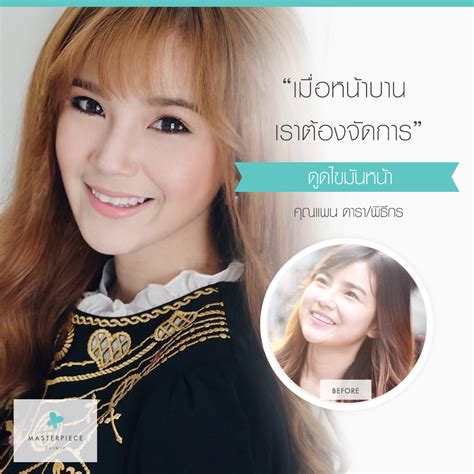 ดูดไขมันหน้า Facial Vaser Liposuction Masterpiece Clinic By Drsae